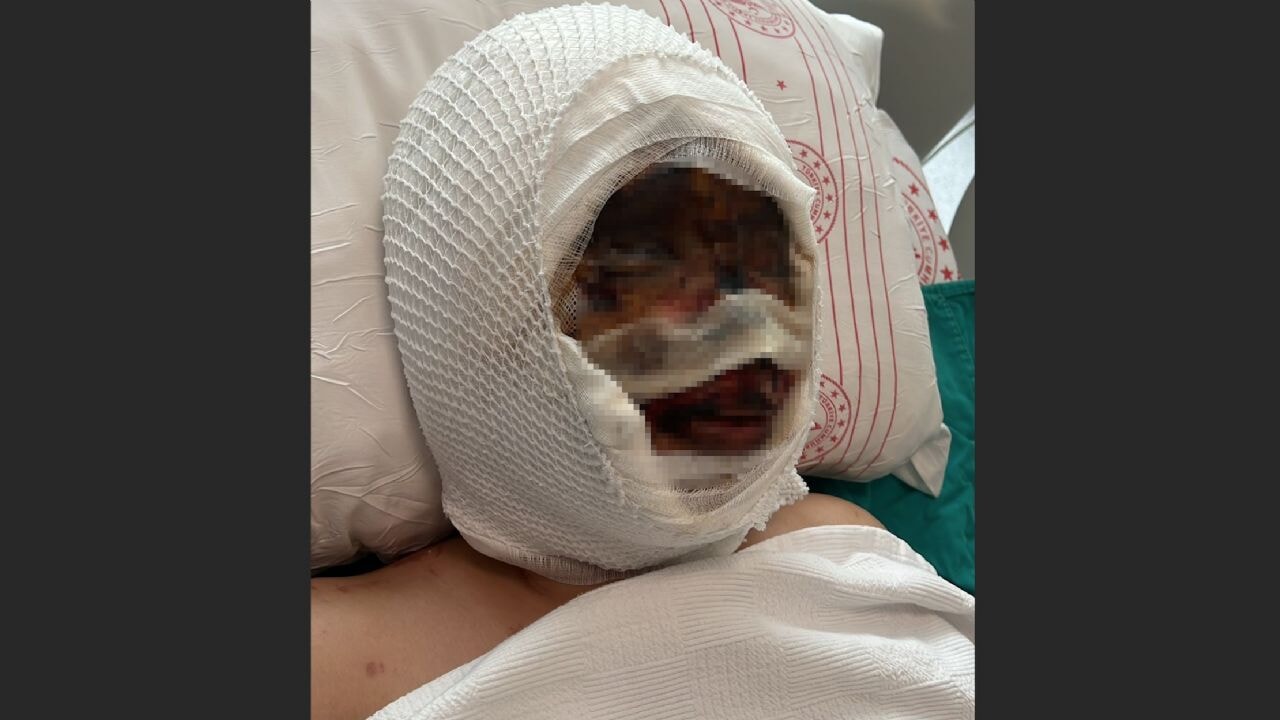 Eski kocası başından aşağı asit döktü!