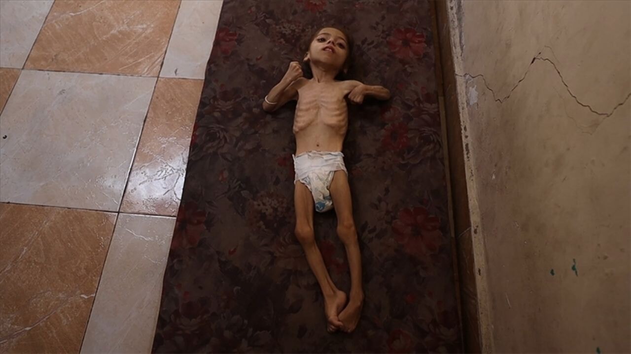 İsrail'in kıtlığa sürüklediği Gazze'de küçük kız kemik yığınına dönüştü