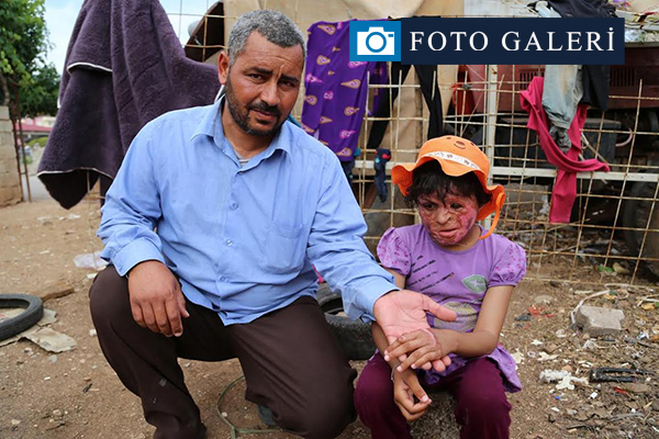 Suriyeli Emira'nın yüzündeki savaşın izleri silinecek