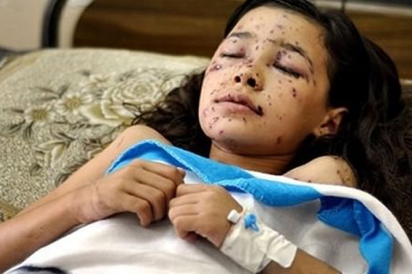 İsrail kör etti, doktorlar göz taktı