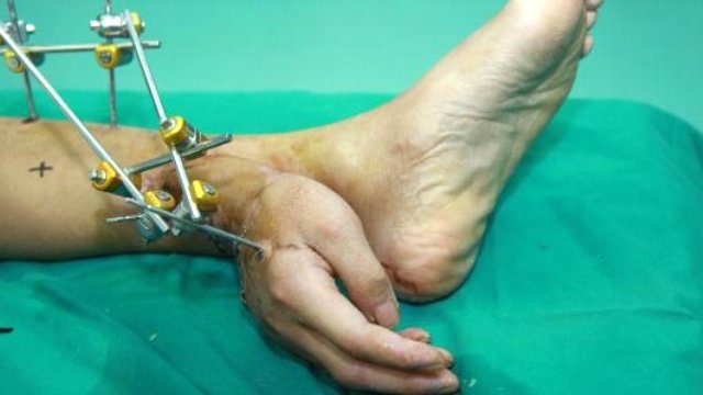 Kopan elini ayağına diktiler