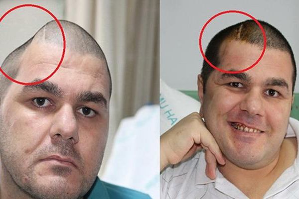 3 boyutlu tedavi sayesinde kafa tasını geri kazandı