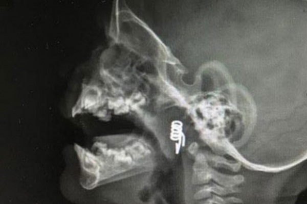 1 yaşındaki bebeğin nefes borusundan çıktı