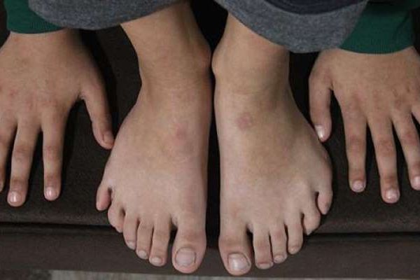 24 parmaklı çocuk için vali devreye girdi