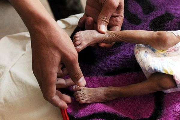 Yemen'de 6 bin 700'den fazla çocuk öldü veya yaralandı