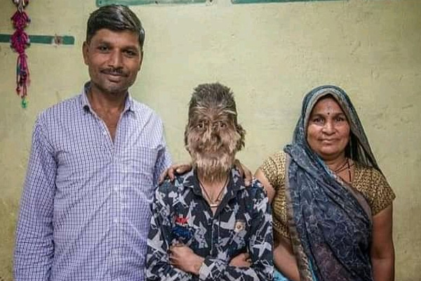 Hintli öğrenci sadece 50 kişide görülen hastalığa yakalandı