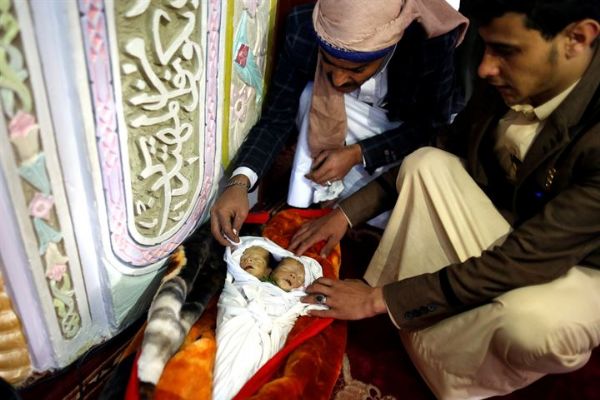 Yemende yeni doğan yapışık ikizler hayatını kaybetti