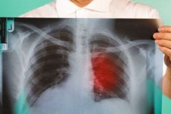 Göğüs ağrısının önemli 5 nedeni