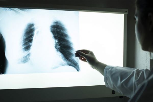 'Kanserin arttığı büyük şehirlerde Batılı yaşam tarzı öne çıkıyor'