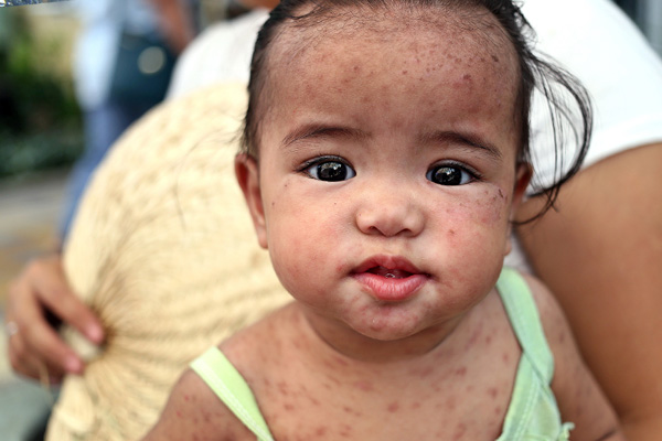 UNICEF'den hastalık uyarısı: Yılın ilk 3 ayında yüzde 300 arttı