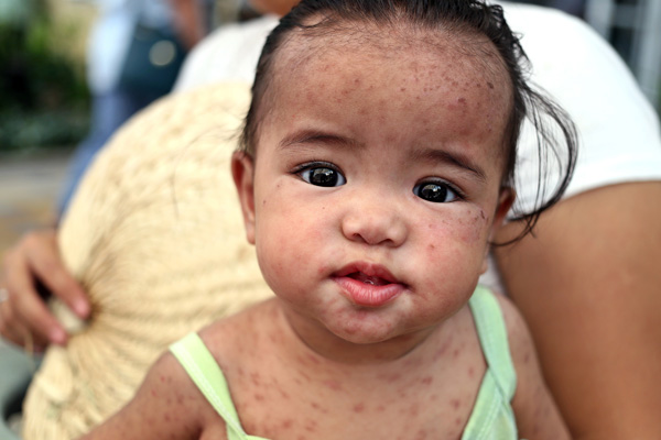 Filipinler'de kızamık salgını: 415 ölü