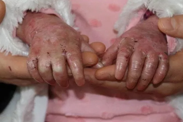 ABD yaptırımları İran'daki 'kelebek hastaları'nın hayatını riske atıyor