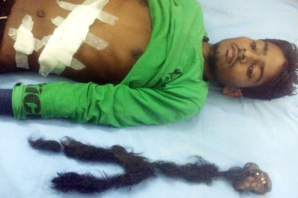 Karnından ikiz kardeşi çıktı