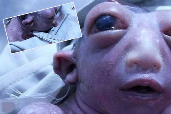 Yarım kafayla doğan bebek iki gün yaşadı