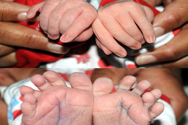 24 parmaklı olarak doğdu