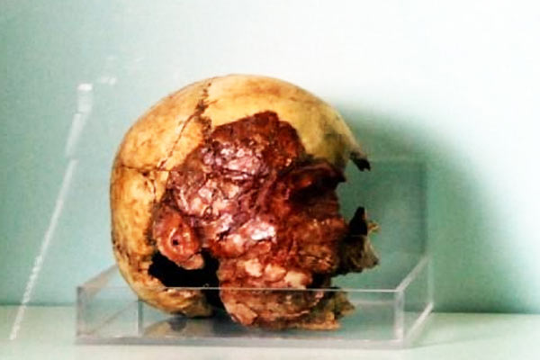 7 bin 200 yıllık kafatası