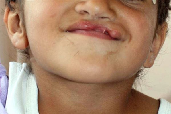 Gebelikte ilaç kullanımında 'dudak ve damak yarığı' riski