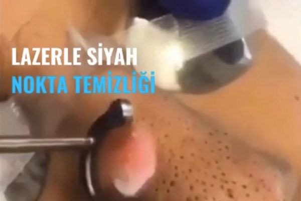 Lazerle siyah nokta temizliği yapılışı