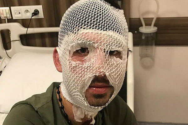 Yunan polisi sığınmacıyı kaynar suyla yaraladı