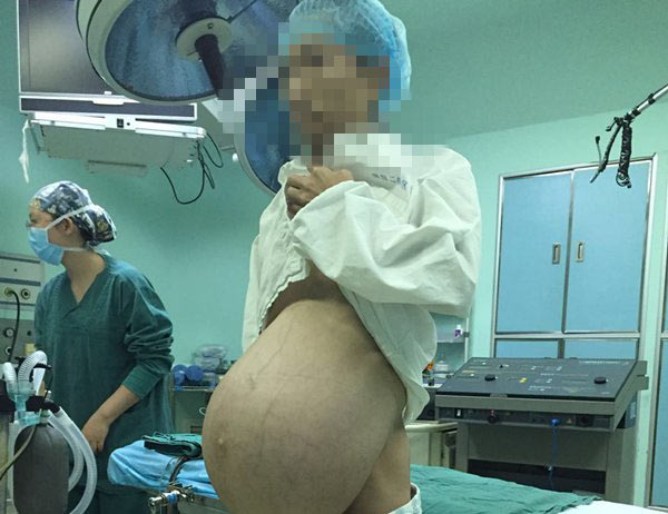 Karnından 15 kiloluk tümör çıktı