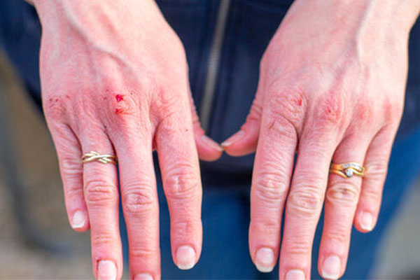 Doç. Dr. Zekayi Kutlubay: Kurdeşen de, koronavirüs belirtisi olabilir