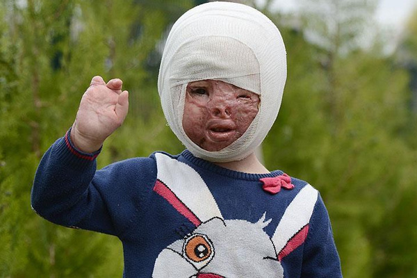 Suriyeli minik Cene'nin büyük dramı