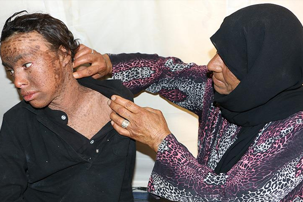 Suriyeli genç balık pulu hastalığıyla mücadele ediyor