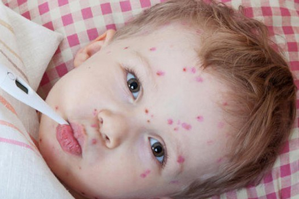 Bakanlık noktayı koydu: Su çiçeği salgını yok