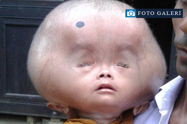 Minik çocuğun kafası tam 9 kilo ağırlığında