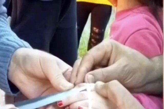(Özel) İstanbul'da parmağını sıkıştıran küçük kıza maket bıçaklı müdahale