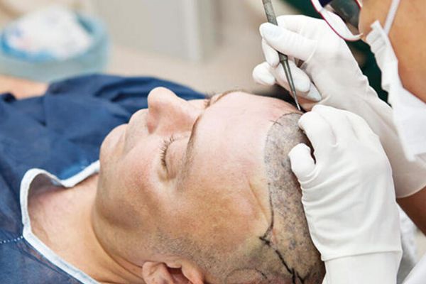 “Türkiye’ye saç ekimi için gelenlerin çoğu Avrupalı'