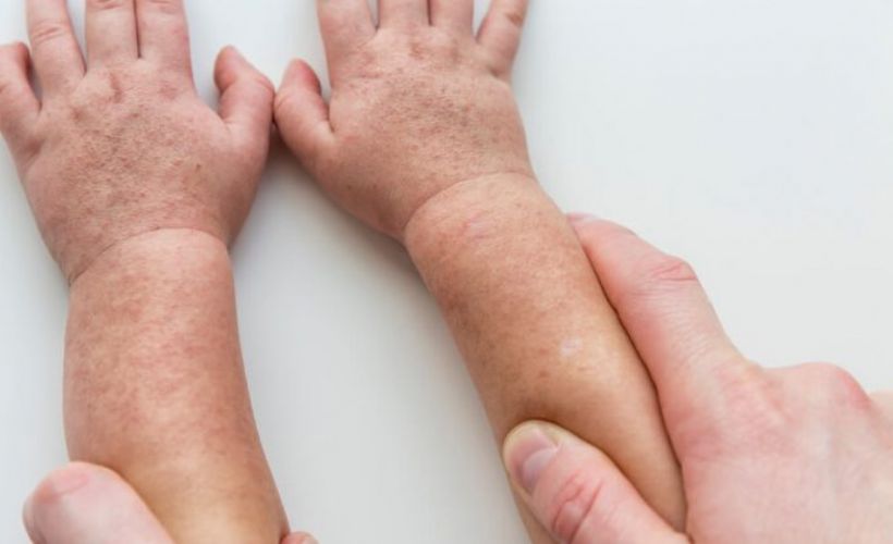 Kızıl hastalığı nedir ? Kızıl hastalığı ne kadar sürer ?  Kızıl hastalığı'nın tedavi süreci ne ?