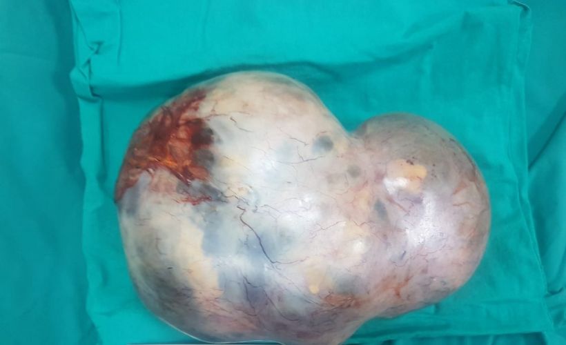 17 yaşındaki kızın karnından 5 kiloluk tümör çıktı, doktor gözlerine inanamadı
