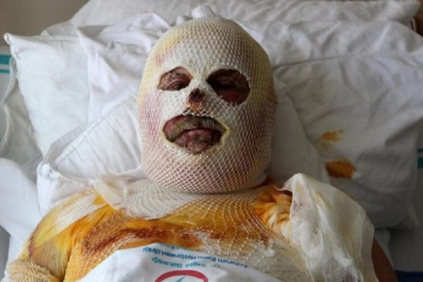 Sobada çay yapmak isteyen isteyen adam feci şekilde yandı