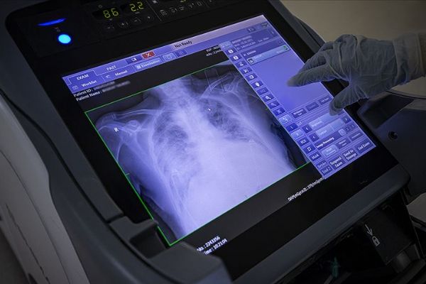 Türkiye'de son 24 saatte 1703 kişiye Kovid-19 tanısı konuldu