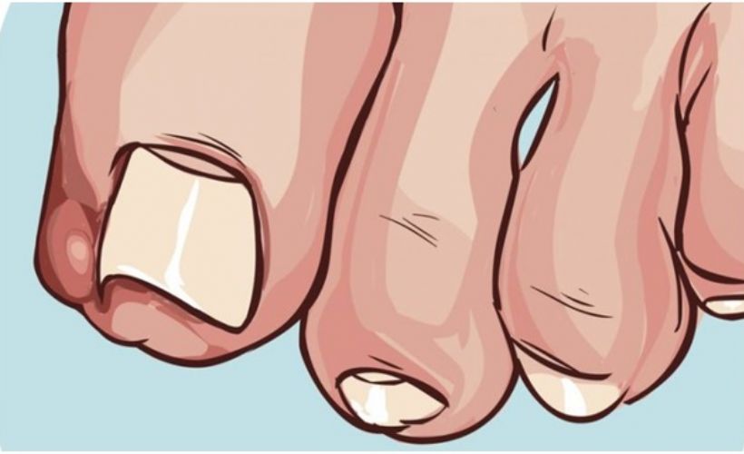 Batık Tırnak Tedavisinde Güncel Yöntemler