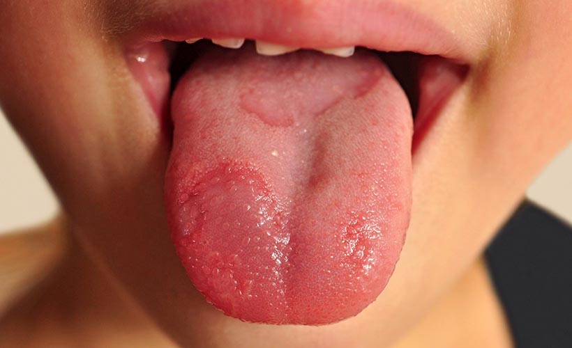 Ağız ülserinden kurtulmak için 4 doğal ipucu