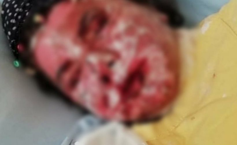 Stevens Johnson sendromu nedir? Stevens Johnson belirtileri ve nedenleri nelerdir?