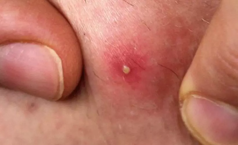 Geçmeyen sivilce sebepleri | Yetişkinlerde sivilce neden çıkar?