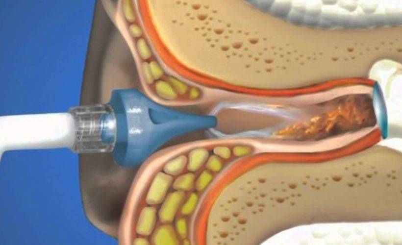 Kulak yıkatmak oruç bozar mı? Hastanede kulak temizletmek oruca etki eder mi?