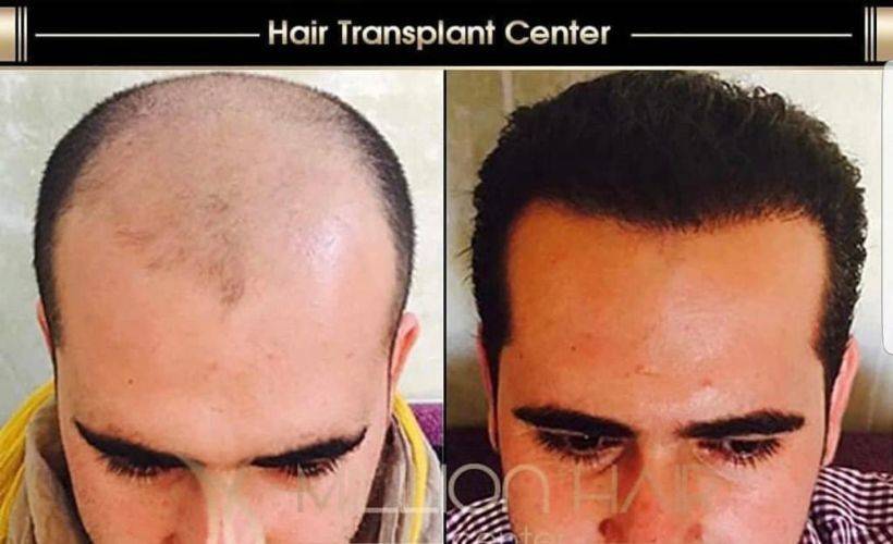 Million Hair Center Markasının CEO’su Fatih Köse: Saç ve Sakal Ekiminde Yeni Yöntemler Deniyoruz