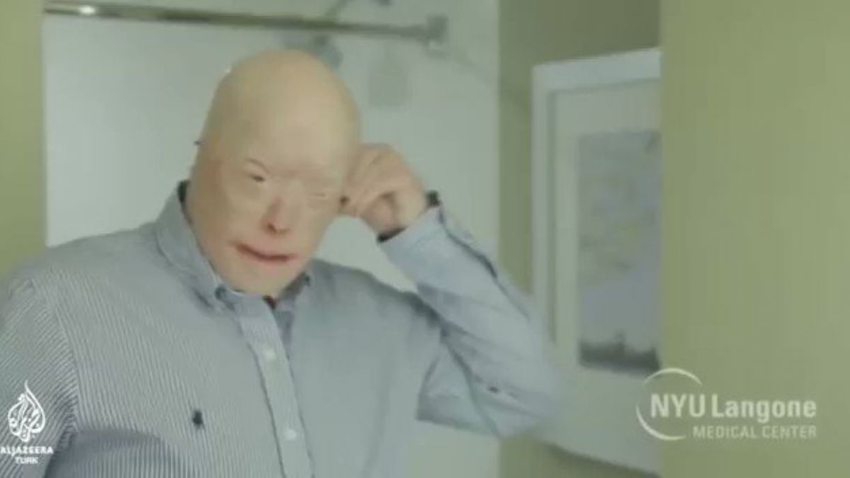 Dünyanın en kapsamlı yüz nakli gerçekleşti