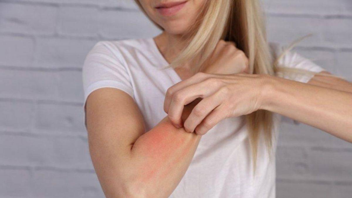 Alerjiler Hakkında Bilinmesi Gerekenler