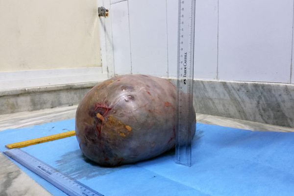 Karnından 7 Kg ağırlığında tümör çıkarıldı