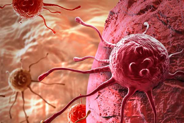 Yılda 174 bin kişi kansere yakalanıyor