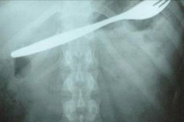 Midesinden çatal çıktı!