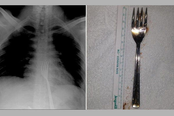Konyalı genç 15 santimetrelik çatal yuttu