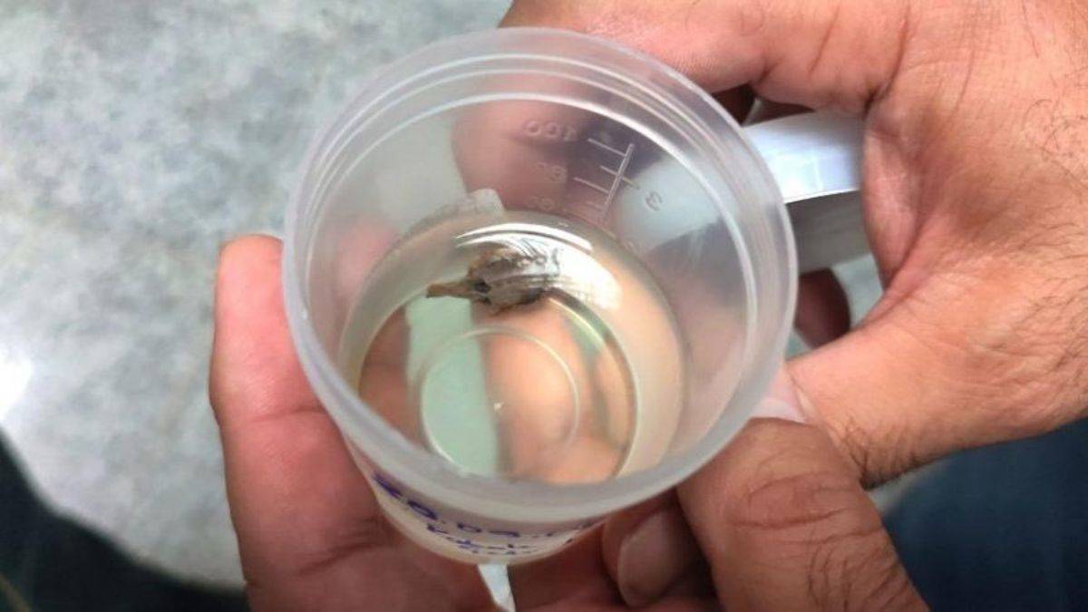 Akciğerindeki kabak çekirdeği operasyonla alındı