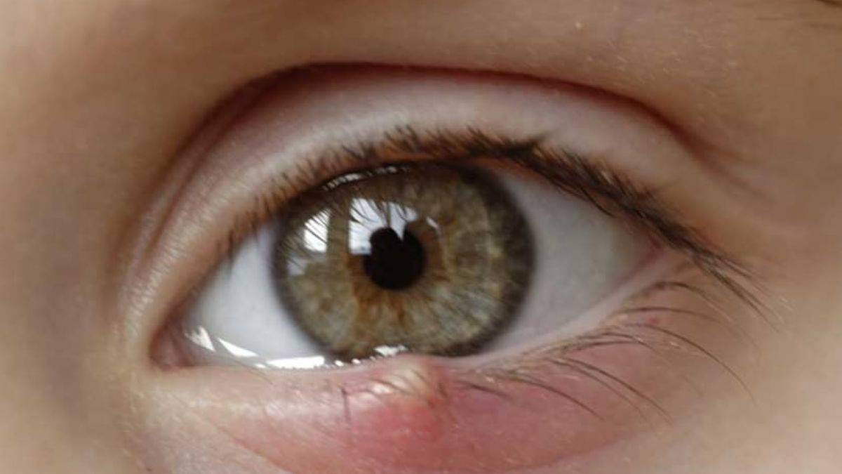 Gözümüzde neden arpacık çıkar?