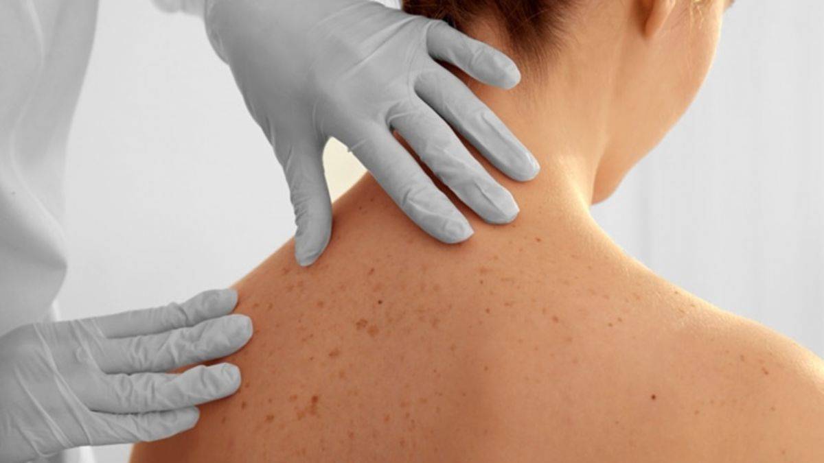 Sırtta sivilce çıkması nasıl önlenir?